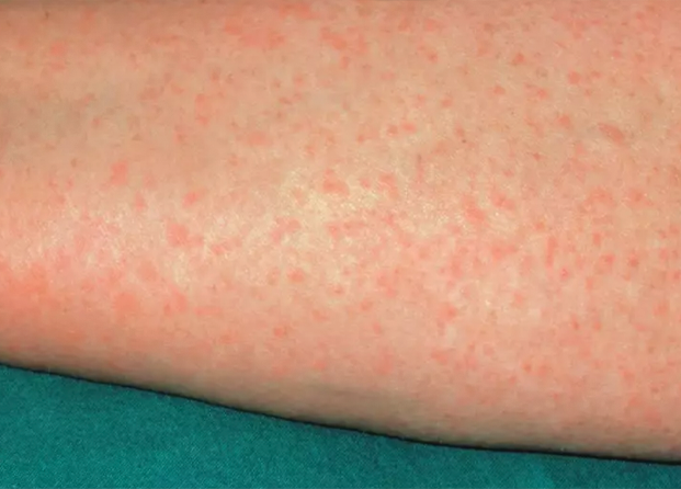 Allergy5 Allergy5