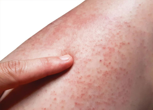 Allergy6 Allergy6